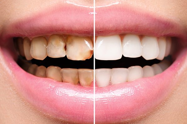 Dental-Restoration