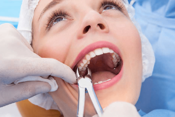 Tooth-Extraction