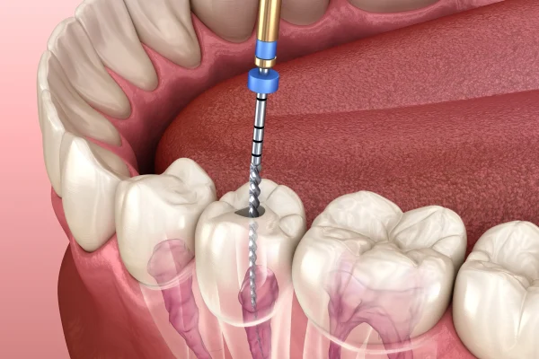 cc-dental-root-canal-diagram