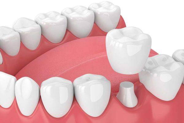 dental-crown-bridge-dental-service-1024x768