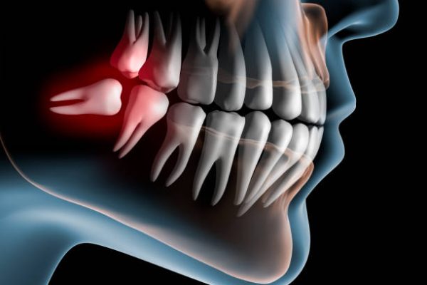 Reclining wisdom tooth in the lower jaw in front of dark background - 3D Illustration